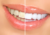 Teeth Whitening - Dentist Budd Lake NJ